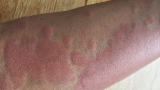 forearm with large hives depicting histamine intolerance