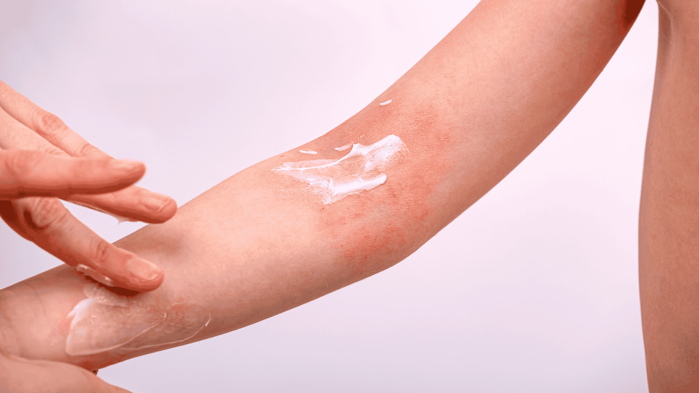 a closeup of a child's arm, having cream rubbed into eczema patch. 